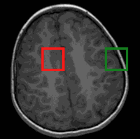 brain_mri_progression.gif